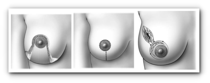 Органосохраняющие операции при раке груди 1