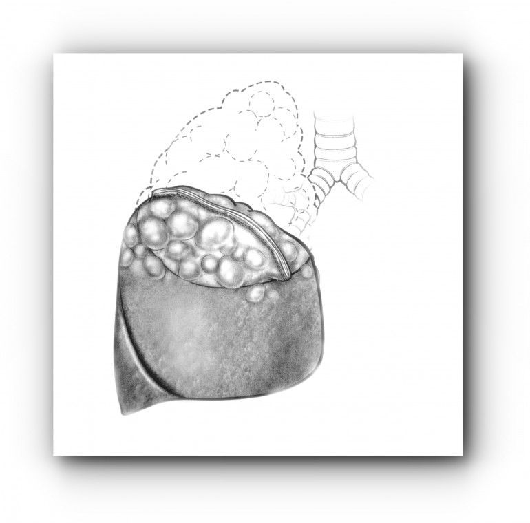 Лечение спонтанного пневмоторакса, торакоскопическое удаление булл 2