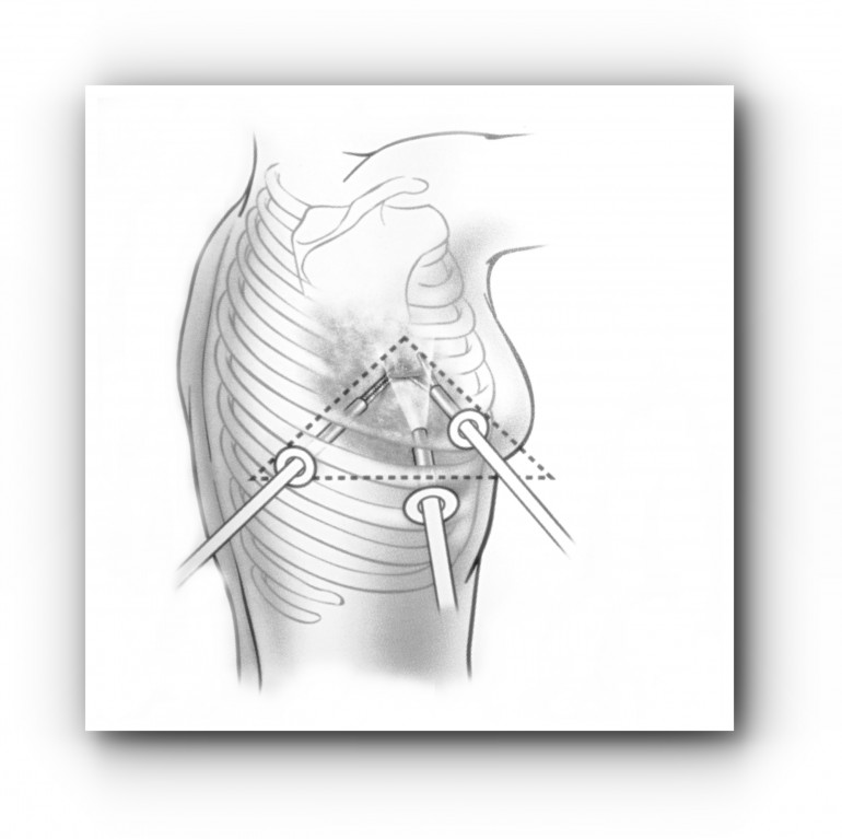 Торакоскопия — видеохирургическое вмешательство в грудной полости 1