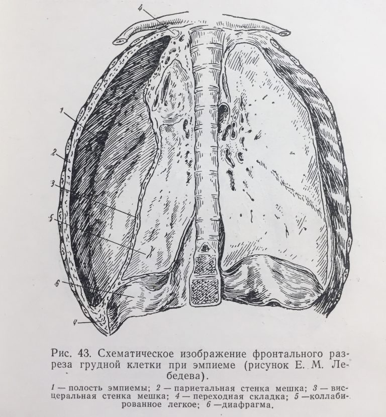 Эмпиема плевры кт фото